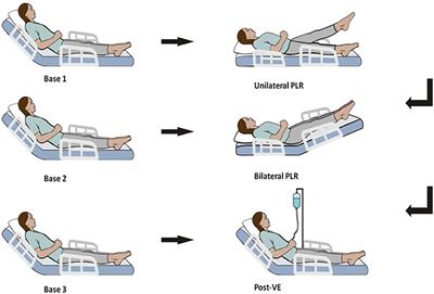 Changes in the Cardiac Index Induced by Unilateral Passive Leg Raising in Spontaneously Breathing Patients: A Novel Way to Assess Fluid Responsiveness